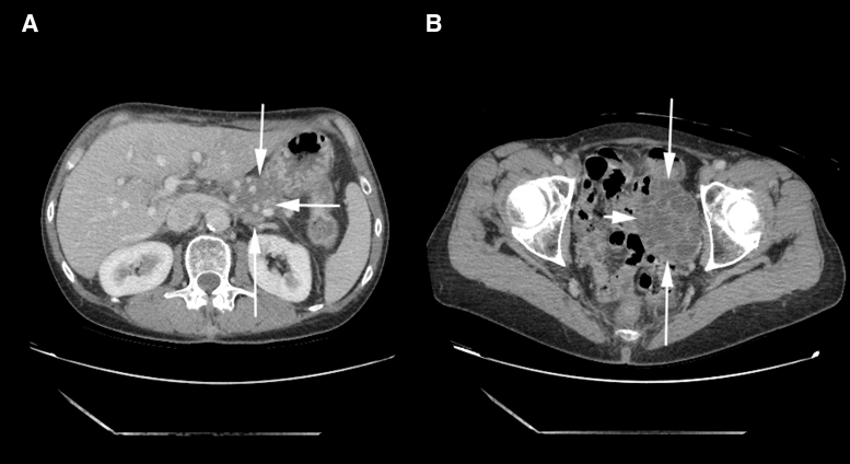 Isolated Ovarian Metastasis from Pancreatic Cancer Mimicking Primary Ovarian Neoplasia: Role of Molecular Analysis in Determining Diagnosis.