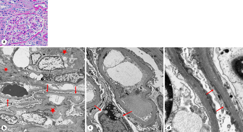 Recurrent Glomerular Diseases in Renal Transplantation with Focus on Role of Electron Microscopy.