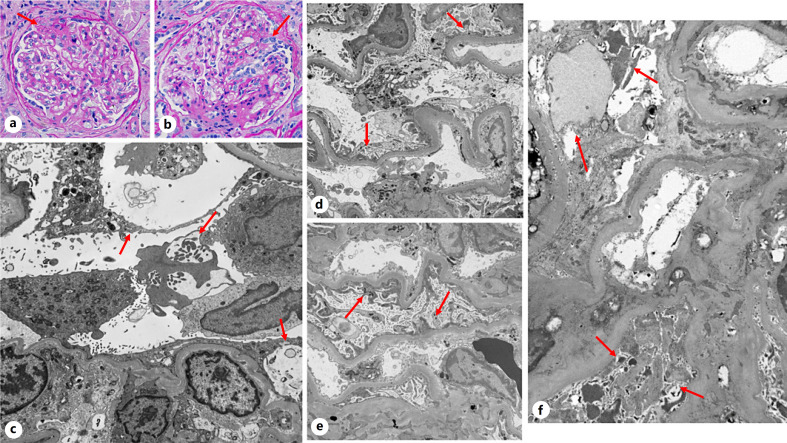 Recurrent Glomerular Diseases in Renal Transplantation with Focus on Role of Electron Microscopy.