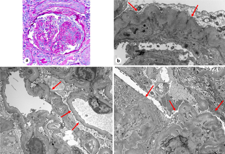 Recurrent Glomerular Diseases in Renal Transplantation with Focus on Role of Electron Microscopy.