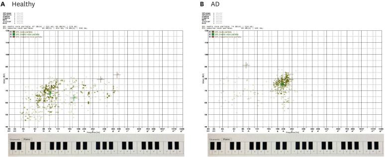 Changes in Speech Range Profile Are Associated with Cognitive Impairment.