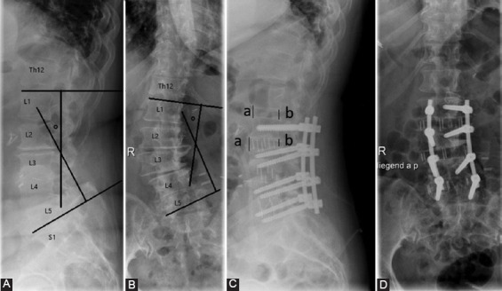 Extreme lateral interbody fusion (XLIF) in a consecutive series of 72 patients.