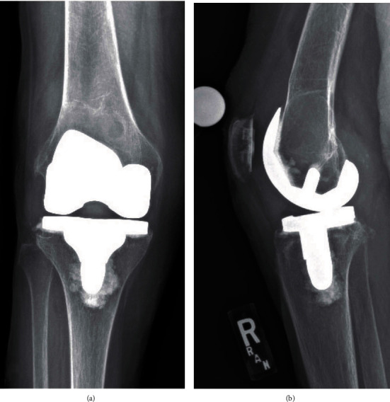 Massive Osteolysis in a Modern Total Knee Prosthesis.