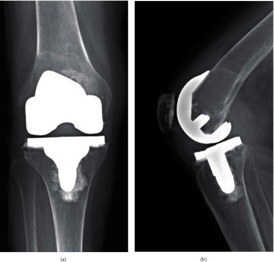 Massive Osteolysis in a Modern Total Knee Prosthesis.