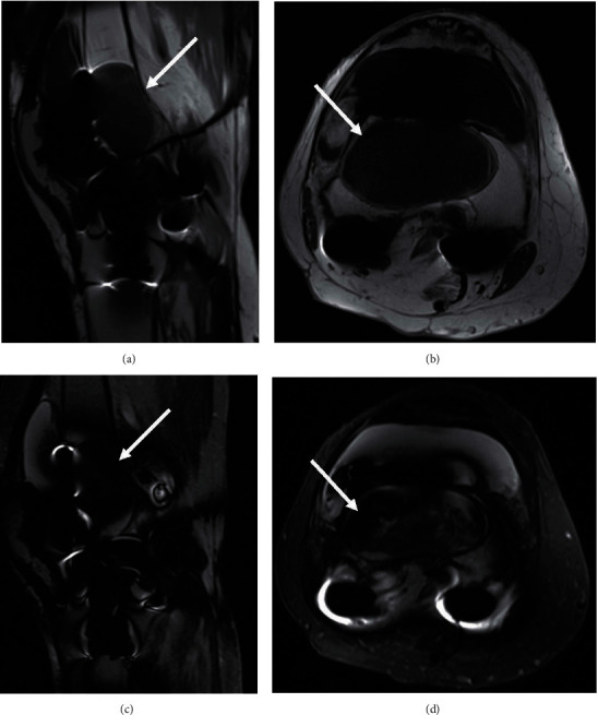 Massive Osteolysis in a Modern Total Knee Prosthesis.