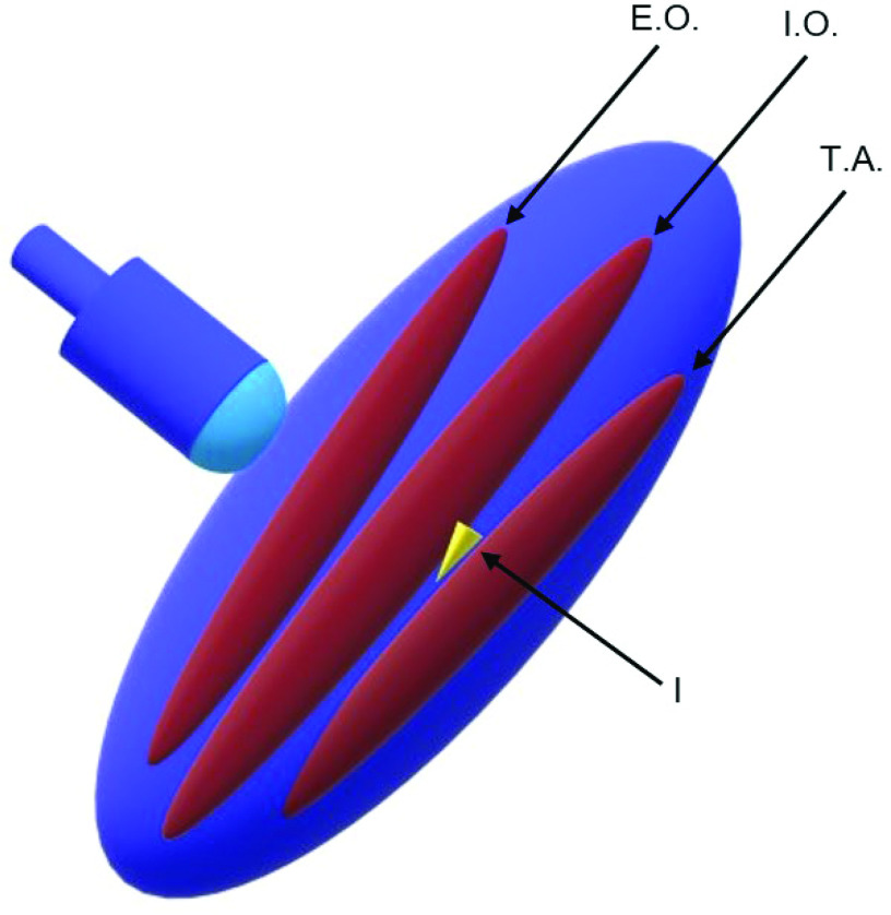 Does Transverse Abdominis Plane Block Increase the Risk of Postoperative Urinary Retention after Inguinal Hernia Repair?