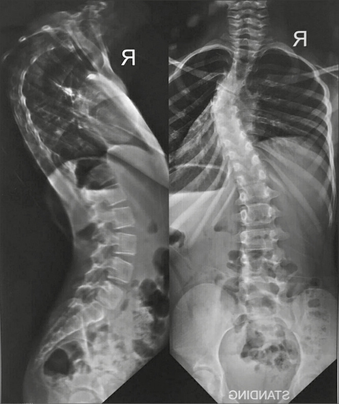 Case Report of Congenital Kyphoscoliosis with Myotonic Dystrophy Type 1: Perioperative and Anesthetic Considerations.