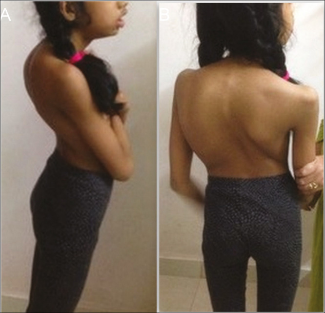 Case Report of Congenital Kyphoscoliosis with Myotonic Dystrophy Type 1: Perioperative and Anesthetic Considerations.