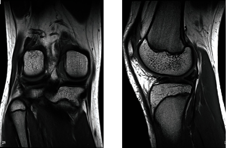 Surgical Treatment of Double-Layered Lateral Meniscus.