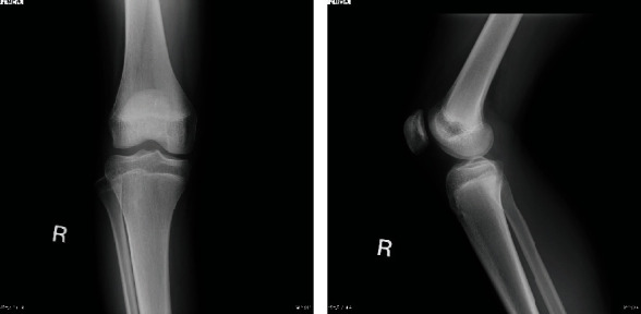 Surgical Treatment of Double-Layered Lateral Meniscus.