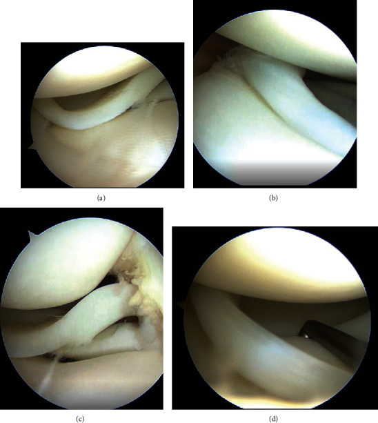 Surgical Treatment of Double-Layered Lateral Meniscus.