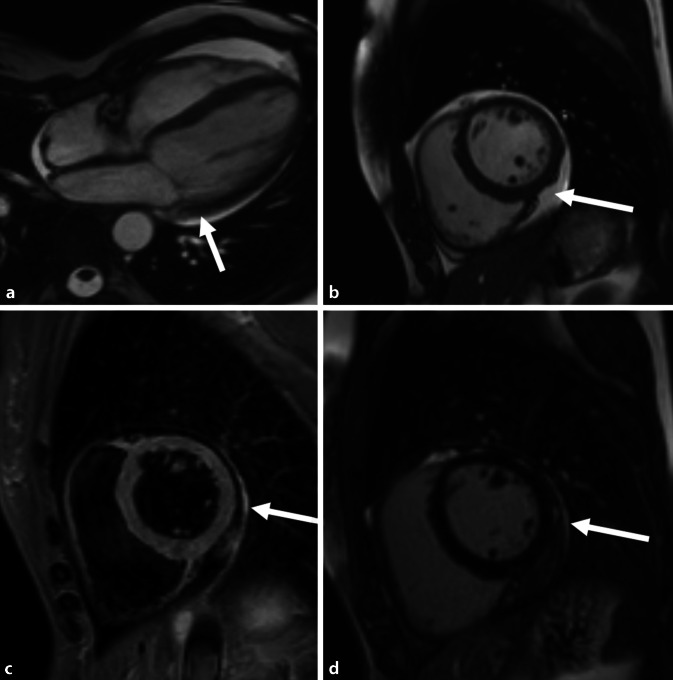 [Acute and chronic cardiac involvement in COVID-19].