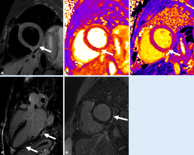 [Acute and chronic cardiac involvement in COVID-19].