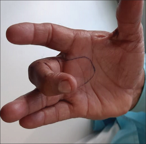 <i>Agnikarma</i> with <i>Kshaudra</i> (honey) along with adjuvant <i>Ayurveda</i> therapy in the management of trigger finger- A single case report.