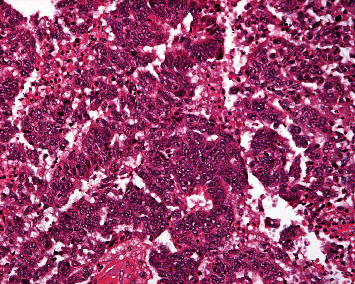 Primary Fallopian Tube Cancer in an 89-Year-Old Patient.