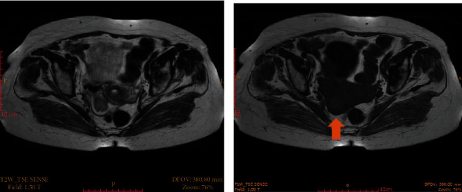 Primary Fallopian Tube Cancer in an 89-Year-Old Patient.