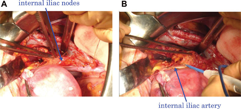 The Okabayashi Radical Hysterectomy: Basic Principle and Step-by-Step Procedure.