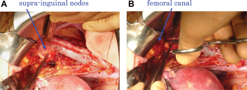 The Okabayashi Radical Hysterectomy: Basic Principle and Step-by-Step Procedure.