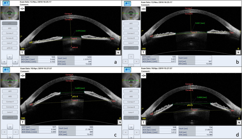 Dynamic assessment of variations in pupil diameter using swept-source anterior segment optical coherence tomography after phakic collamer lens implantation.