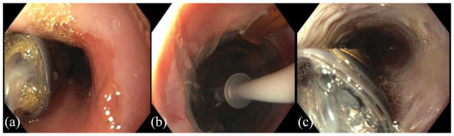 The role of ablation in the treatment of dysplastic Barrett's esophagus.