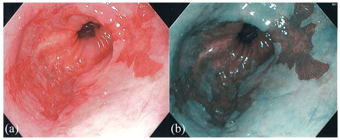 The role of ablation in the treatment of dysplastic Barrett's esophagus.