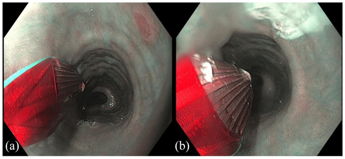 The role of ablation in the treatment of dysplastic Barrett's esophagus.