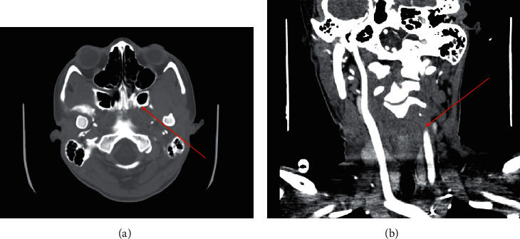 Multiple Cranial Nerve Palsies in a Pediatric Case of Lemierre's Syndrome due to <i>Streptococcus viridans</i>.