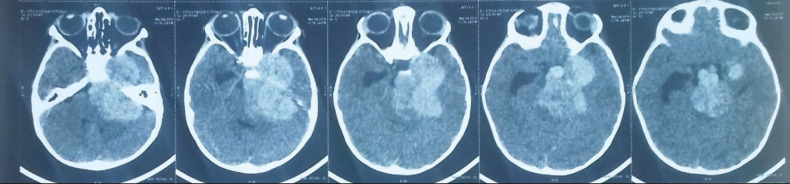 Pediatric Skull Base Meningioma: Case Report and Review of Literature.