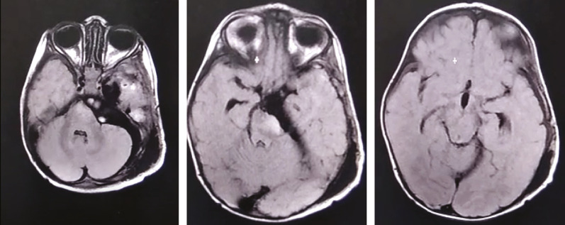 Pediatric Skull Base Meningioma: Case Report and Review of Literature.