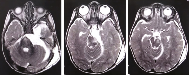 Pediatric Skull Base Meningioma: Case Report and Review of Literature.