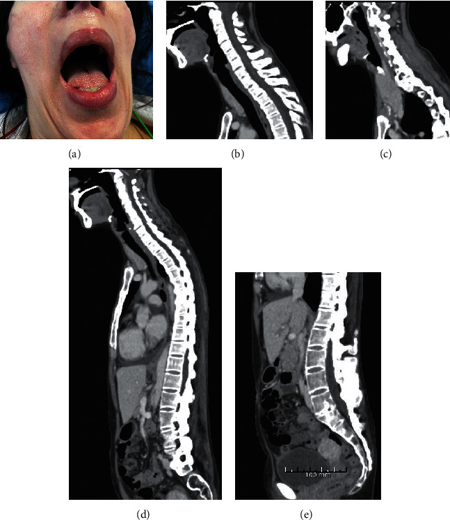 Managing Known Difficult Airways in Obstetric Patients Using a Flexible Bronchoscope and IRRIS: A Case-Illustrated Guide for Nonexpert Anesthesiologists, without Surgical Backup.