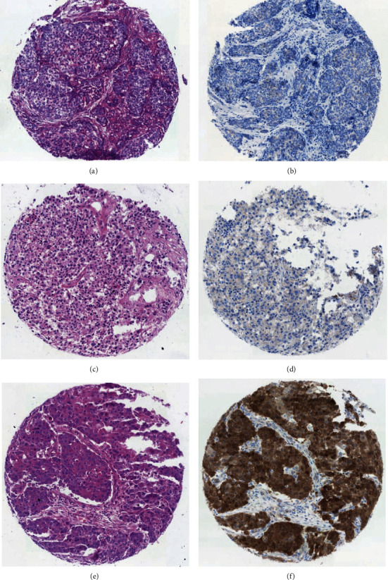 Detection of High- and Low-Risk HPV DNA in Archived Breast Carcinoma Tissues from Ethiopian Women.