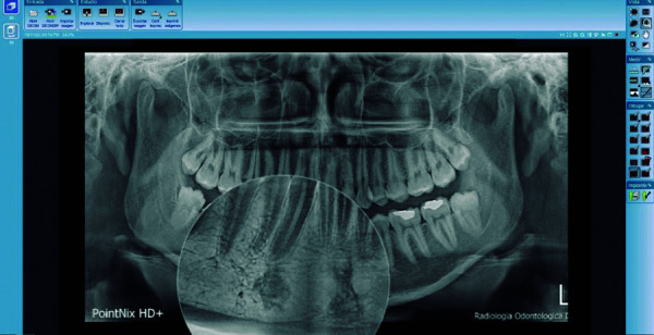 [Prevalence of idiopathic osteosclerosis in patients cared for at a radiological center in Ayacucho from 2016-2018].
