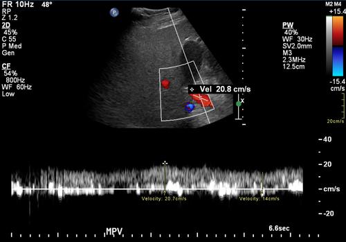 Portal Venous Pulsatility Index as a predictor of fibrosis in patients with non-alcoholic fatty liver disease