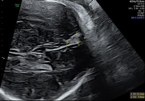 Fetal dural sinus malformation: A case report and discussion of the literature