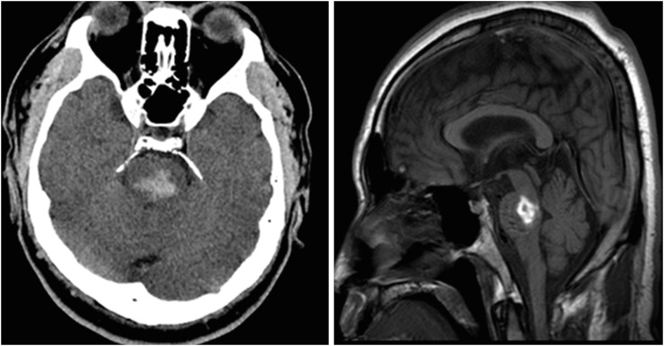 Hemidystonia after Pontine Hemorrhage Successfully Treated with Pharmacotherapy and Intensive Rehabilitation: a Case Report.