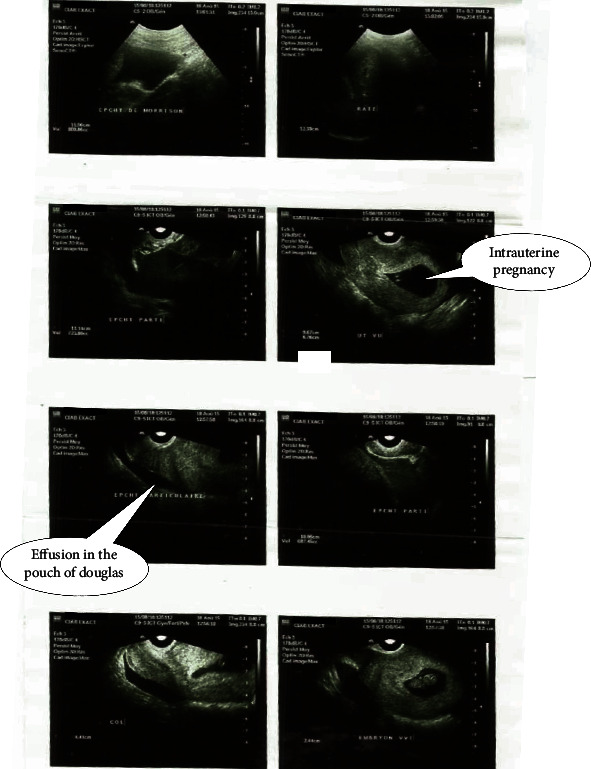 Pitfalls in Diagnosing Heterotopic Pregnancy in Sub-Saharan Africa: A Case Report at the Yaounde University Teaching Hospital (Cameroon).