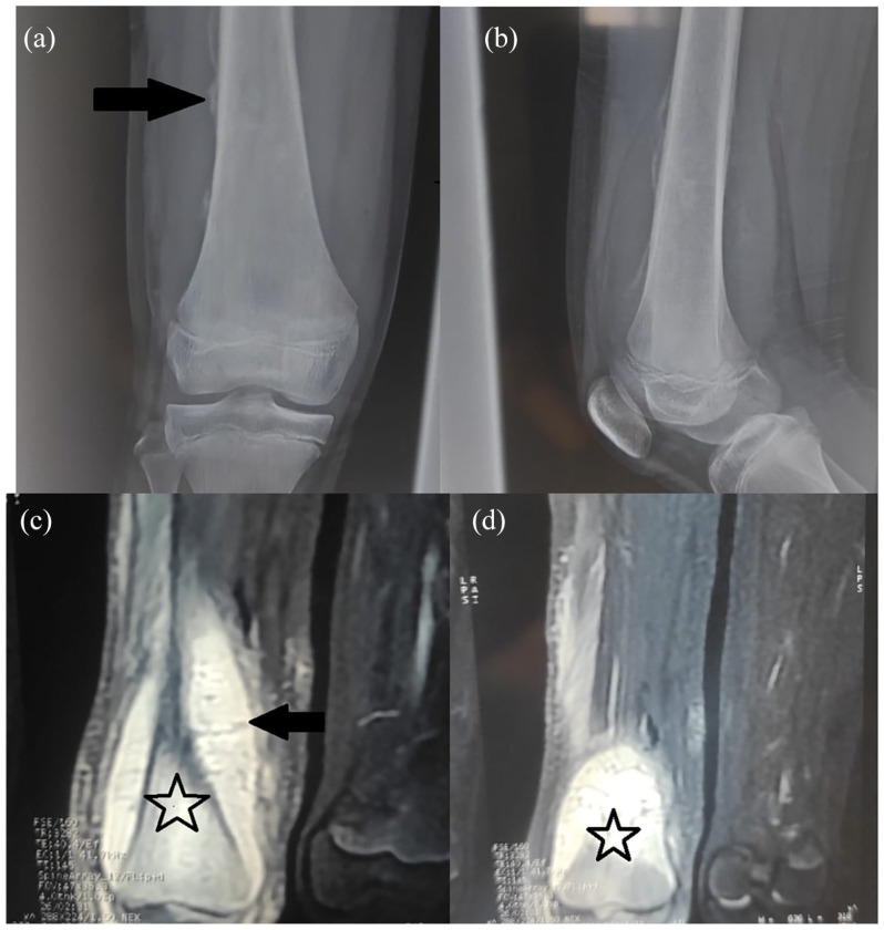 Chondromyxoid Fibroma-Like Osteosarcoma in a 13 Years Old Girl: A Report of a New Case.