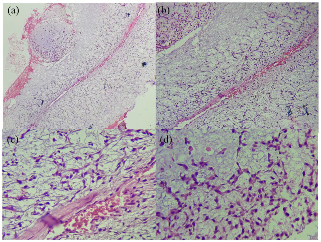 Chondromyxoid Fibroma-Like Osteosarcoma in a 13 Years Old Girl: A Report of a New Case.