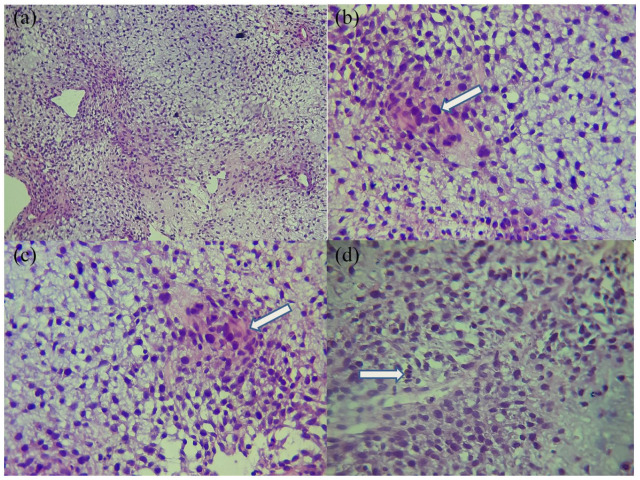 Chondromyxoid Fibroma-Like Osteosarcoma in a 13 Years Old Girl: A Report of a New Case.
