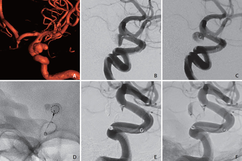 Adjustment of Malpositioned Woven EndoBridge Device Using Gooseneck Snare: Complication Management Technique.