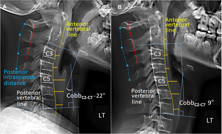 Cervicogenic Dizziness in an 11-Year-Old Girl: A Case Report.