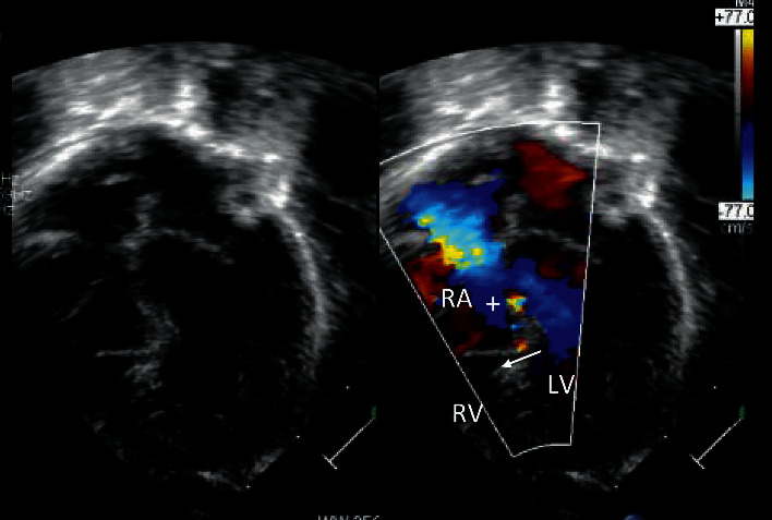 Ebstein's Anomaly, Left Ventricular Noncompaction and Gerbode-Like Defect Triad (Fetal Diagnosis and Neonatal Course).