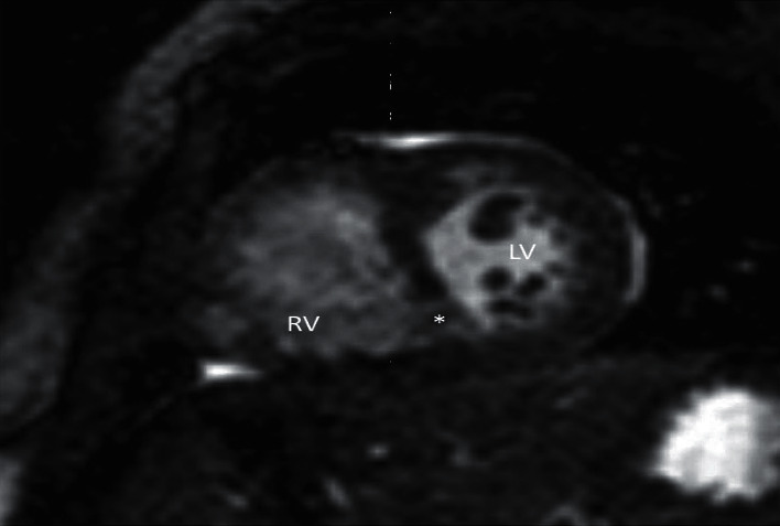 Ebstein's Anomaly, Left Ventricular Noncompaction and Gerbode-Like Defect Triad (Fetal Diagnosis and Neonatal Course).