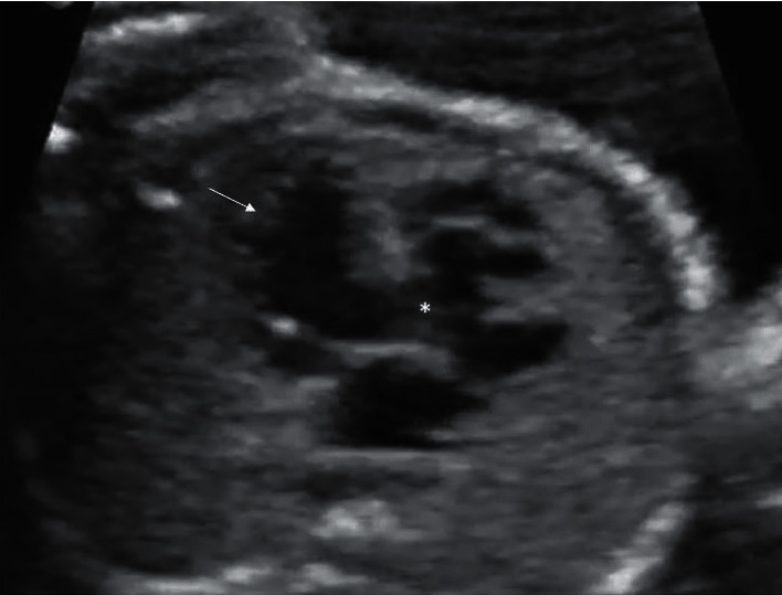 Ebstein's Anomaly, Left Ventricular Noncompaction and Gerbode-Like Defect Triad (Fetal Diagnosis and Neonatal Course).