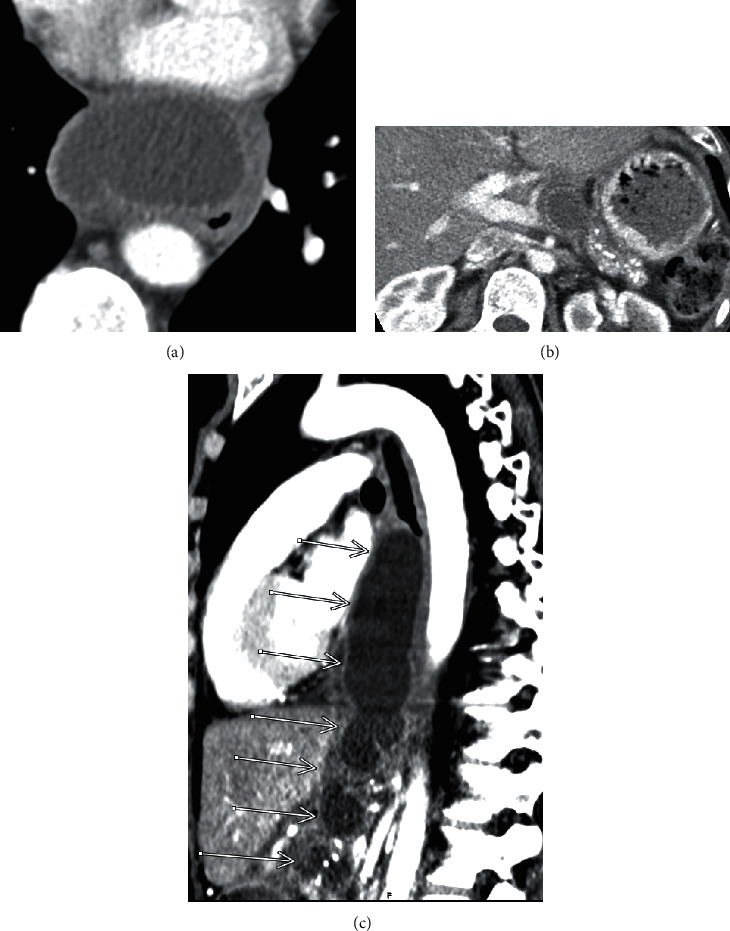 Mediastinal Extension of a Pancreatic Pseudocyst: A Rare Intrathoracic Complication of Pancreatitis.