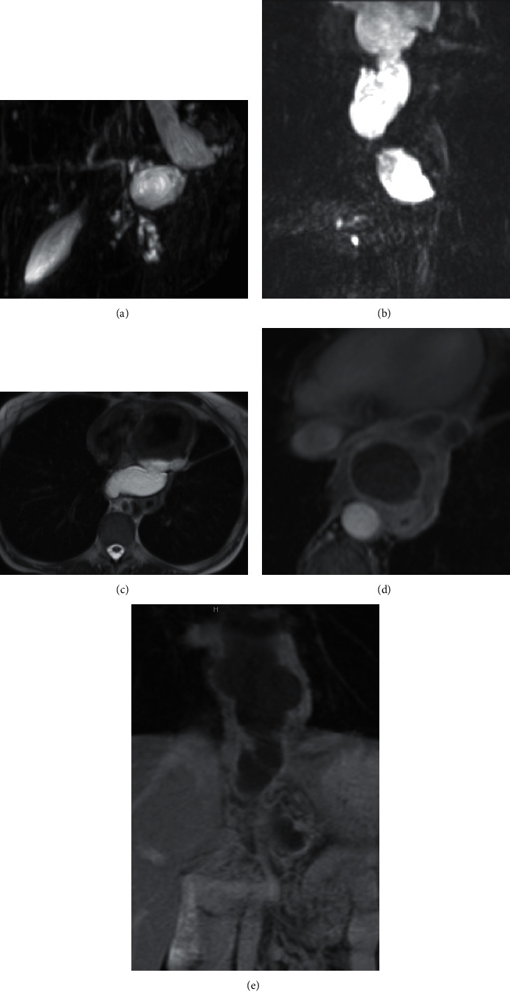 Mediastinal Extension of a Pancreatic Pseudocyst: A Rare Intrathoracic Complication of Pancreatitis.