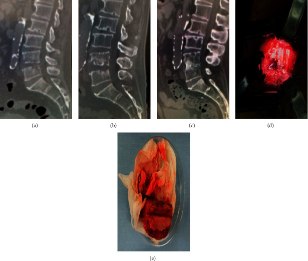 The Limitation of Endoscopic Surgery Using the Full Endoscopic Discectomy System for the Treatment of Destructive Stage Pyogenic Spondylodiscitis: A Case Series.