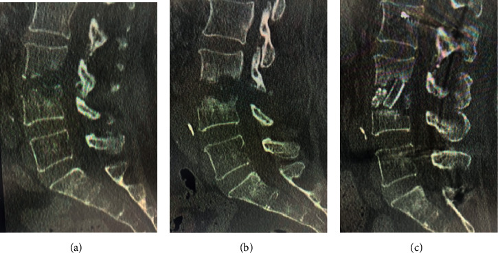 The Limitation of Endoscopic Surgery Using the Full Endoscopic Discectomy System for the Treatment of Destructive Stage Pyogenic Spondylodiscitis: A Case Series.