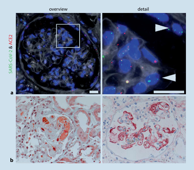 COVID-19 effects on the kidney.